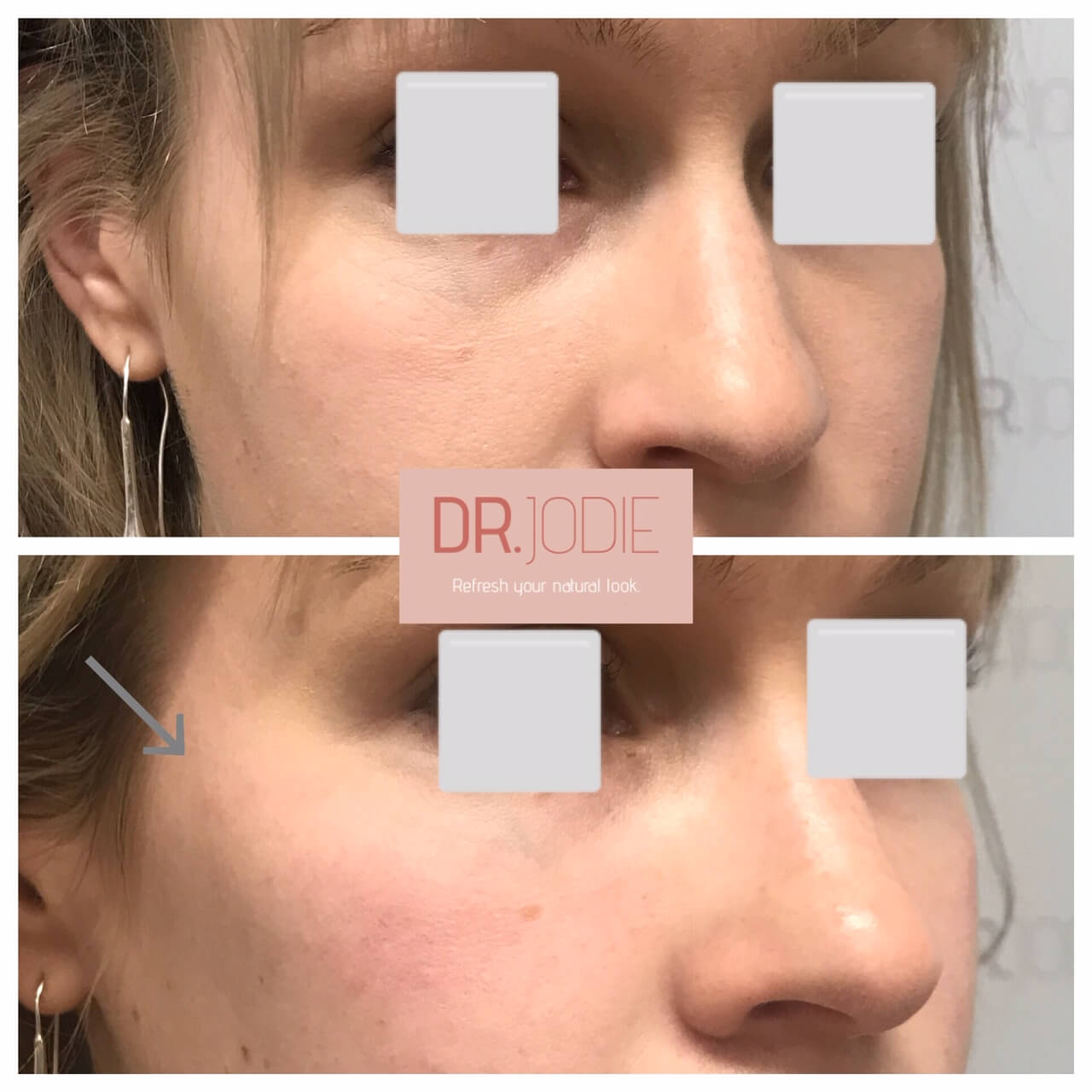 Enhanced Cheeks Dermal Filler Right 45 Dr Jodie Surrey Hills Melbourne