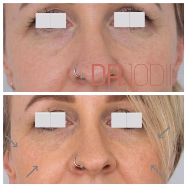 Mid Facelift Facial Rejuvenation Dermal Filler Front Dr Jodie Surrey Hills Melbourne