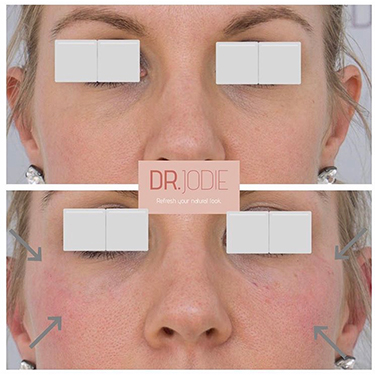 Cheek Fillers Melbourne | Dr. Jodie