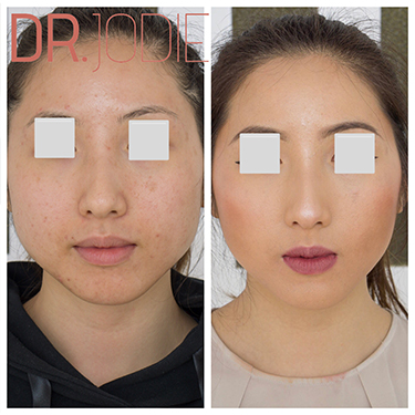 facial slimming melbourne cea mai bună grăsime burn gnc