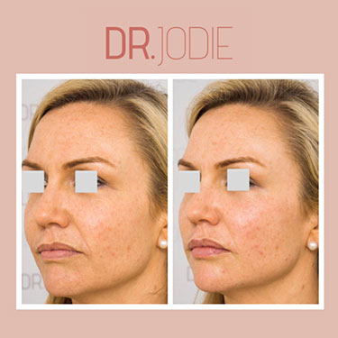 Nasolabial Folds Melbourne | Dr. Jodie