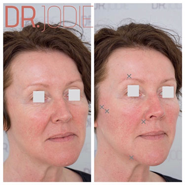 pierde greutate nasolabial folds