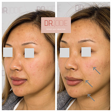 pierde greutate nasolabial folds