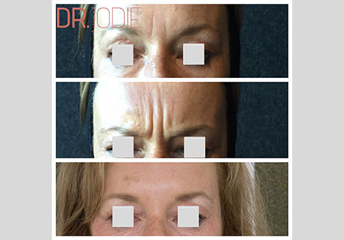 Anti Wrinkle Injections Dermal Filler Frown Dr Jodie Surrey Hills Melbourne