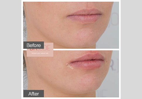 Barely There Lip Filler Dr Jodie Surrey Hills Melbourne