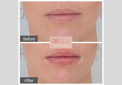 Barely There Subtle Lip Filler Front Dr Jodie Silleri Surrey Hills Melbourne