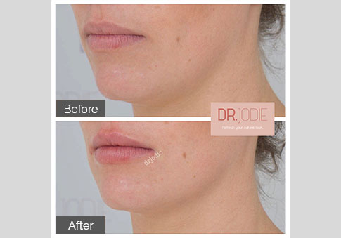 Lip Fillers Melbourne - Ilana Galgut