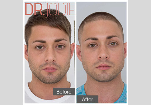 Cheek Filler Male Tear Troughs Cheeks Dr Jodie Surrey Hills Melbourne Copy