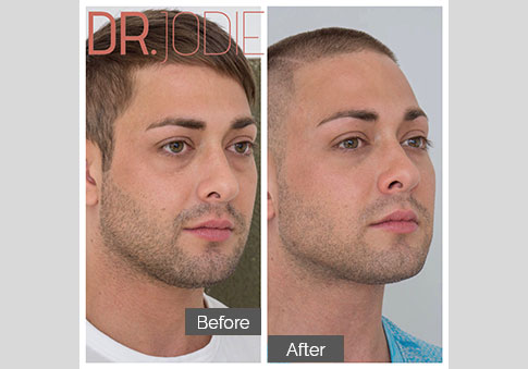 Cheek Filler Tear Trough Filler Male Face Dr. Jodie Surrey Hills Melbourne Copy