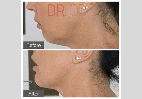 Chin Filler Dr Jodie Surrey Hills Melbournejpg