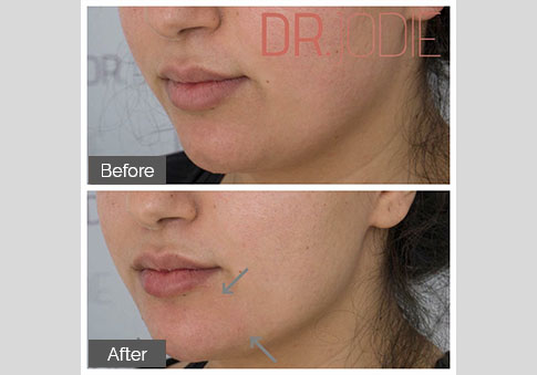 Chin Projection Marionettes Dermal Filler Dr Jodie Surrey Hills Melbourne