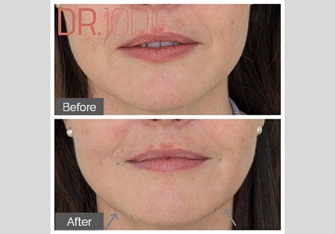 Dermal Filler Marionettes Dr Jodie Surrey Hills Melbourne