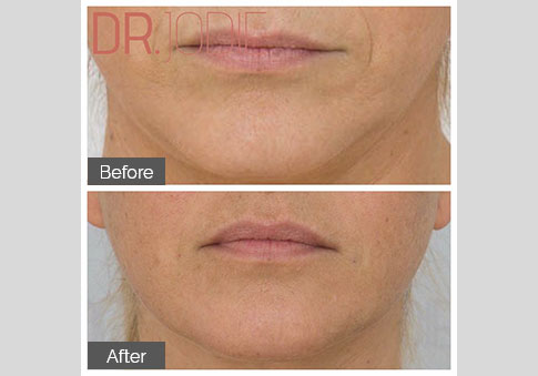 Dermal Filler Marionettes Nasolabial Folds Dr Jodie Surrey Hills Melbourne