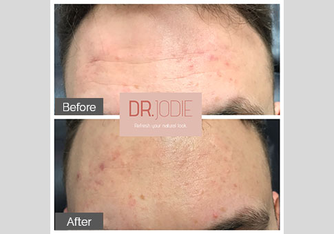 Forehead Lines Dr Jodie Surrey Hills Melbourne