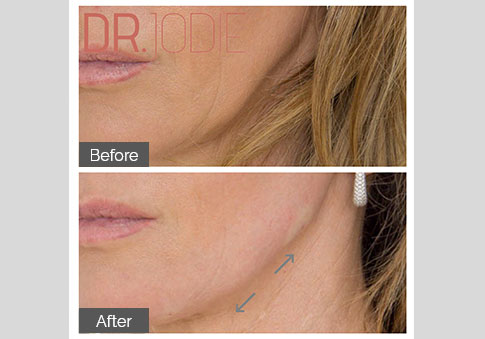 Jawline Straightening Dr Jodie Surrey Hills Melbourne