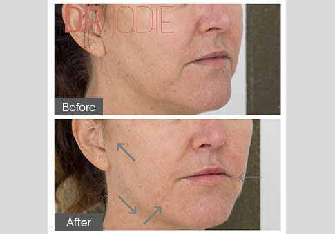 Jowls Jawline. Lower Face Lift Dr Jodie Surrey Hills Melbourne