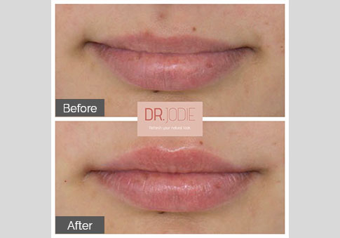 Lip Asymmetry Correction Dermal Filler Dr Jodie Surrey Hills Melbourne