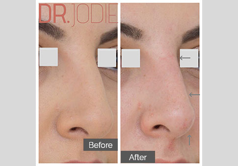 Liquid Nose Job Dr Jodie Surrey Hills Melbourne