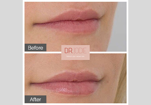 Soft Lip Filler Dr Jodie Surrey Hills Melbourne