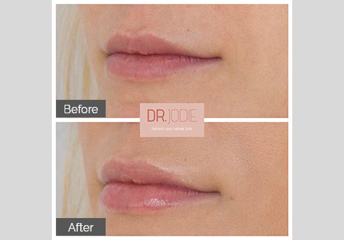 Soft Lip Filler Lateral View Right Dr Jodie Surrey Hills Melbourne