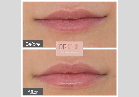 Soft Lips Dr Jodie Surrey Hills Melbourne