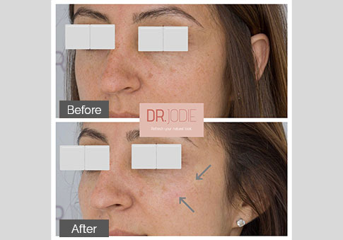 Subtle Cheek Tear Trough Filler Side View Left Dr Jodie Surrey Hills Melbourne