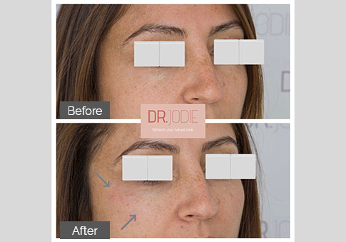 Subtle Cheek Tear Trough Filler Side View Right Dr Jodie Surrey Hills Melbourne