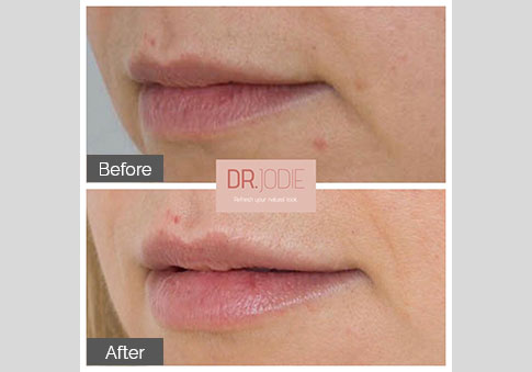 Subtle Lip Filler Dr Jodie Surrey Hills Melbourne