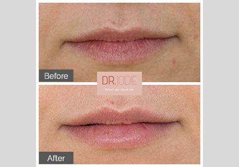 Subtle Lip Filler Front Dr Jodie Surrey Hills Melbourne