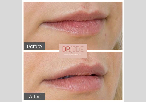 Subtle Lip Filler Right Side Dr Jodie Surrey Hills Melbourne