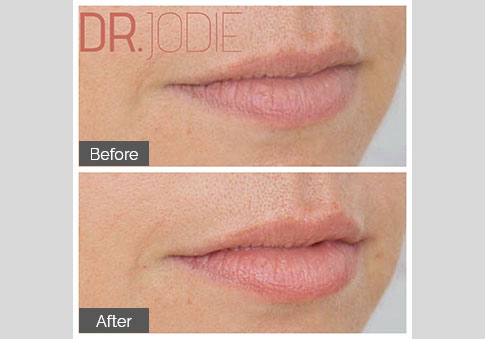 Super Subtle Lip Filler Dr Jodie Surrey Hills Melbourne