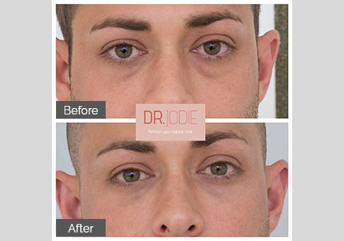 Tear Troughs Derrmal Filler Male Face Dr Jodie Surrey Hills Melbourne