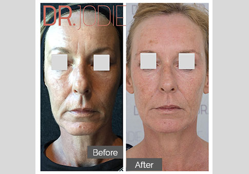 Whole Face Jawline Filler Dr Jodie Surrey Hills Melbourne Front