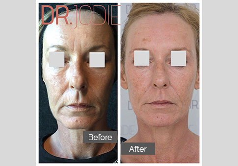 Whole Face Jawline Filler Dr Jodie Surrey Hills Melbourne Front