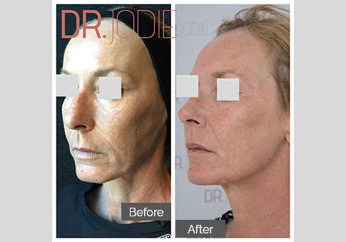 Whole Face Jawline Filler Dr Jodie Surrey Hills Melbourne Side Left