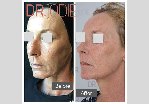 Whole Face Jawline Filler Dr Jodie Surrey Hills Melbourne Side Left