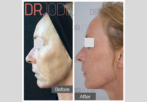 Whole Face Jawline Filler Dr Jodie Surrey Hills Melbourne Side Left 90