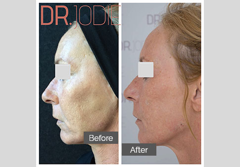 Whole Face Jawline Filler Dr Jodie Surrey Hills Melbourne Side Left 90