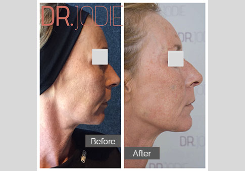 Whole Face Jawline Filler Dr Jodie Surrey Hills Melbourne Side Right 90